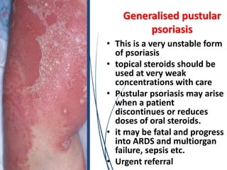 Generalised pustular
psoriasis
• This is a very unstable form
of psoriasis
• topical steroids should be
used at very weak
concentrations with care
• Pustular psoriasis may arise
when a patient
discontinues or reduces
doses of oral steroids.
• it may be fatal and progress
into ARDS and multiorgan
failure, sepsis etc.
• Urgent referral
 