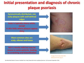 Initial presentation and diagnosis of chronic
plaque psoriasis
Symmetrically distributed, red,
scaly plaques with well-defined
edges
Scale is typically silvery white,
except
in skin folds where plaques appear
shiny
Most common sites are
scalp, elbows and knees
Itch is mostly mild but may be
severe in some patients, leading
to scratching and lichenification
DermNet New Zealand. Psoriasis. Available from: https://www.dermnetnz.org/topics/psoriasis. Last accessed: September 2018.
Images from DermNet NZ,
www.dermnet.org.nz
 
