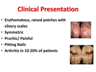 Clinical Presentation
• Erythematous, raised patches with
silvery scales
• Symmetric
• Pruritic/ Painful
• Pitting Nails
• Arthritis in 10-20% of patients
 