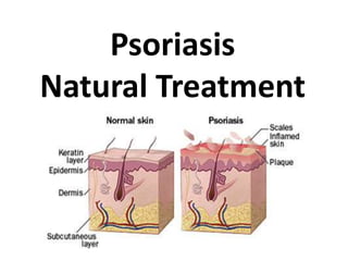 Psoriasis
Natural Treatment
 