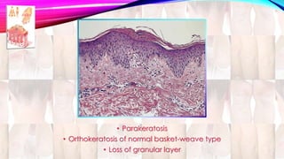 • Parakeratosis 
• Orthokeratosis of normal basket-weave type 
• Loss of granular layer 
 