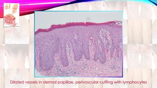 Dilated vessels in dermal papillae, perivascular cuffing with lymphocytes 
 