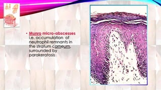 • Munro micro-abscesses 
i.e. accumulation of 
neutrophil remnants in 
the stratum corneum, 
surrounded by 
parakeratosis 
 