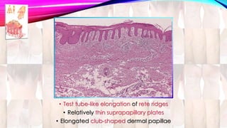 • Test tube-like elongation of rete ridges 
• Relatively thin suprapapillary plates 
• Elongated club-shaped dermal papillae 
 