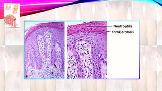 Neutrophils 
Parakeratosis 
 