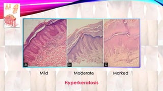 Mild Moderate Marked 
Hyperkeratosis 
 