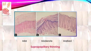 Mild Moderate Marked 
Suprapapillary thinning 
 