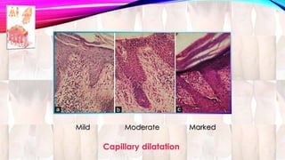 Mild Moderate Marked 
Capillary dilatation 
 