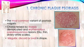 • The most common variant of psoriasis 
vulgaris. 
• Characterized by sharply 
demarcated and erythematous 
papulosquamous lesions (Dry, thin, 
silvery-white scales). 
• Irregular, discoid or oval in shape. 
 