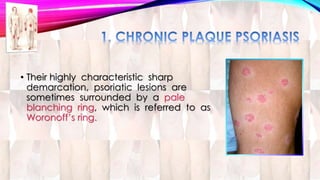 • Their highly characteristic sharp 
demarcation, psoriatic lesions are 
sometimes surrounded by a pale 
blanching ring, which is referred to as 
Woronoff’s ring. 
 