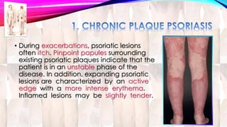 • During exacerbations, psoriatic lesions 
often itch. Pinpoint papules surrounding 
existing psoriatic plaques indicate that the 
patient is in an unstable phase of the 
disease. In addition, expanding psoriatic 
lesions are characterized by an active 
edge with a more intense erythema. 
Inflamed lesions may be slightly tender. 
 