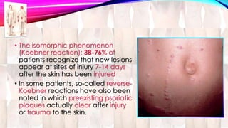 • The isomorphic phenomenon 
(Koebner reaction): 38-76% of 
patients recognize that new lesions 
appear at sites of injury 7-14 days 
after the skin has been injured 
• In some patients, so-called reverse- 
Koebner reactions have also been 
noted in which preexisting psoriatic 
plaques actually clear after injury 
or trauma to the skin. 
 