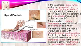 • If the superficial silvery white 
scales are removed via 
curettage (grattage method), 
a characteristic coherence is 
observed, as if one has scratched 
on a wax candle (“signe de la 
tache de bougie”). 
• Subsequently, a surface 
membrane is seen, which will 
also come off as a whole. 
• If the latter is removed, then a 
wet surface is seen with 
characteristic pinpoint bleeding. 
This finding, called Auspitz sign, is 
the clinical reflection of 
elongated vessels in the dermal 
papillae together with thinning of 
the suprapapillary epidermis. 
 