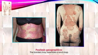 Psoriasis geographica: 
The borders may resemble a land map 
 