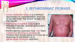 • Lower extremity edema is common 
secondary to vasodilatation and loss 
of protein from the blood vessels into 
the tissues. 
• High-output cardiac failure and 
impaired hepatic and renal function 
may also occur. 
• Erythrodermic psoriasis may start from 
worsening of plaque psoriasis to 
involve most body areas or it may be a 
response to treatment as a 
generalized Koebner reaction. 
 
