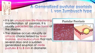 • It is an unusual rare life-threatening 
manifestation of psoriasis, It is 
usually preceded by other forms of 
the disease. 
• The disease occurs abruptly as 
attacks characterized by fever 
malaise, and leukocytosis that lasts 
several days and a sudden 
generalized eruption of sterile 
pustules 2 to 3 mm in diameter. 
 