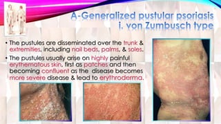 • The pustules are disseminated over the trunk & 
extremities, including nail beds, palms, & soles. 
• The pustules usually arise on highly painful 
erythematous skin, first as patches and then 
becoming confluent as the disease becomes 
more severe disease & lead to erythroderma. 
 