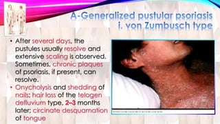 • After several days, the 
pustules usually resolve and 
extensive scaling is observed. 
Sometimes, chronic plaques 
of psoriasis, if present, can 
resolve. 
• Onycholysis and shedding of 
nails; hair loss of the telogen 
defluvium type, 2–3 months 
later; circinate desquamation 
of tongue 
 