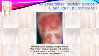 Annular pustular psoriasis. Multiple annular 
inflammatory plaques studded with pustules. 
As the lesions enlarge, there can be central 
clearing, dry desquamation 
 