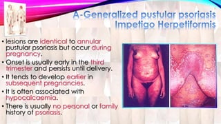 • lesions are identical to annular 
pustular psoriasis but occur during 
pregnancy. 
• Onset is usually early in the third 
trimester and persists until delivery. 
• It tends to develop earlier in 
subsequent pregnancies. 
• It is often associated with 
hypocalcaemia. 
• There is usually no personal or family 
history of psoriasis. 
 