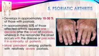 • Develops in approximately 10-30 % 
of those with psoriasis. 
• In approximately 50% of those 
affected arthritis appears one 
decade after the onset of psoriasis, 
whereas in the remainder the onset 
occurs with the disease or precedes 
it In a minority of patients . 
• More prevalent among patients 
with relatively severe psoriasis. 
 