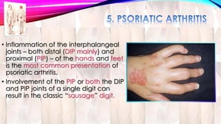 • Inflammation of the interphalangeal 
joints – both distal (DIP mainly) and 
proximal (PIP) – of the hands and feet 
is the most common presentation of 
psoriatic arthritis. 
• Involvement of the PIP or both the DIP 
and PIP joints of a single digit can 
result in the classic “sausage” digit. 
 
