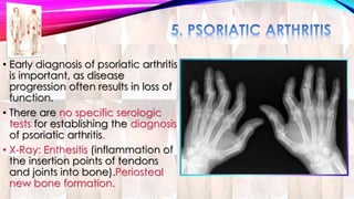 • Early diagnosis of psoriatic arthritis 
is important, as disease 
progression often results in loss of 
function. 
• There are no specific serologic 
tests for establishing the diagnosis 
of psoriatic arthritis. 
• X-Ray: Enthesitis (inflammation of 
the insertion points of tendons 
and joints into bone).Periosteal 
new bone formation. 
 