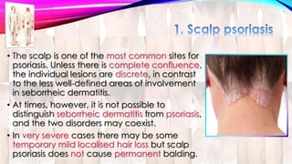 • The scalp is one of the most common sites for 
psoriasis. Unless there is complete confluence, 
the individual lesions are discrete, in contrast 
to the less well-defined areas of involvement 
in seborrheic dermatitis. 
• At times, however, it is not possible to 
distinguish seborrheic dermatitis from psoriasis, 
and the two disorders may coexist. 
• In very severe cases there may be some 
temporary mild localised hair loss but scalp 
psoriasis does not cause permanent balding. 
 