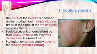 • The back of the head is a common 
site for psoriasis, but multiple discrete 
areas of the scalp or the whole scalp 
may be affected. 
• Scalp psoriasis is characterized by 
thick silvery-white scale over well-defined 
red thickened skin. 
• Psoriasis may extend slightly beyond 
the hairline (facial psoriasis). 
 