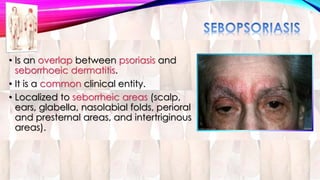 • Is an overlap between psoriasis and 
seborrhoeic dermatitis. 
• It is a common clinical entity. 
• Localized to seborrheic areas (scalp, 
ears, glabella, nasolabial folds, perioral 
and presternal areas, and intertriginous 
areas). 
 