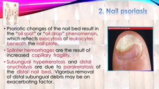 • Psoriatic changes of the nail bed result in 
the “oil spot” or “oil drop” phenomenon, 
which reflects exocytosis of leukocytes 
beneath the nail plate. 
• Splinter hemorrhages are the result of 
increased capillary fragility. 
• Subungual hyperkeratosis and distal 
onycholysis are due to parakeratosis of 
the distal nail bed. Vigorous removal 
of distal subungual debris may be an 
exacerbating factor. 
 