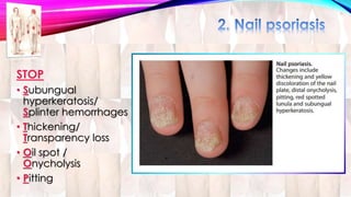 STOP 
• Subungual 
hyperkeratosis/ 
Splinter hemorrhages 
• Thickening/ 
Transparency loss 
• Oil spot / 
Onycholysis 
• Pitting 
 