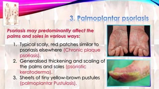 Psoriasis may predominantly affect the 
palms and soles in various ways: 
1. Typical scaly, red patches similar to 
psoriasis elsewhere (Chronic plaque 
psoriasis). 
2. Generalised thickening and scaling of 
the palms and soles (psoriatic 
keratoderma). 
3. Sheets of tiny yellow-brown pustules 
(palmoplantar Pustulosis). 
 