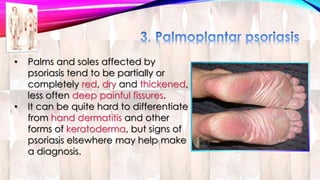 • Palms and soles affected by 
psoriasis tend to be partially or 
completely red, dry and thickened, 
less often deep painful fissures. 
• It can be quite hard to differentiate 
from hand dermatitis and other 
forms of keratoderma, but signs of 
psoriasis elsewhere may help make 
a diagnosis. 
 