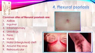 Common sites of flexural psoriasis are: 
1. Axillae 
2. Inguinal 
3. Inframammary 
4. Umbilicus 
5. Penis 
6. Vulva 
7. Natal (intergluteal) cleft 
8. Around the anus 
9. Retroauricular 
 