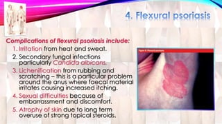 Complications of flexural psoriasis include: 
1. Irritation from heat and sweat. 
2. Secondary fungal infections 
particularly Candida albicans. 
3. Lichenification from rubbing and 
scratching – this is a particular problem 
around the anus where faecal material 
irritates causing increased itching. 
4. Sexual difficulties because of 
embarrassment and discomfort. 
5. Atrophy of skin due to long term 
overuse of strong topical steroids. 
 