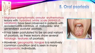 • Migratory asymptomatic annular erythematous 
lesions with hydrated white scale (ANNULUS 
MIGRANS) have been observed in patients with 
acrodermatitis continua of Hallopeau and 
generalized pustular psoriasis. 
• It has been postulated to be an oral variant 
of psoriasis, as these lesions show several 
histologic features of psoriasis. 
• However, geographic tongue is a relatively 
common condition and is seen in many 
nonpsoriatic individuals. 
 