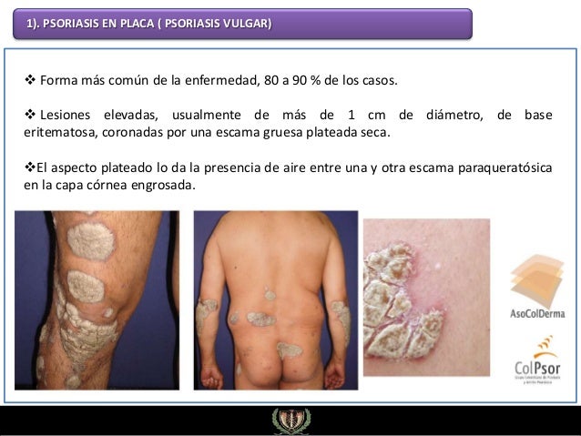 El complejo de las vitaminas del grupo en a la psoriasis