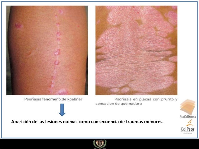 Donde curar la psoriasis en tule