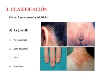 3. CLASIFICACIÓN
A) La juvenil:
1. Piel cabelluda
2. Zona del pañal
3. Uñas
4. Pustulosa
Existen formas Juvenil y del Adulto:
 