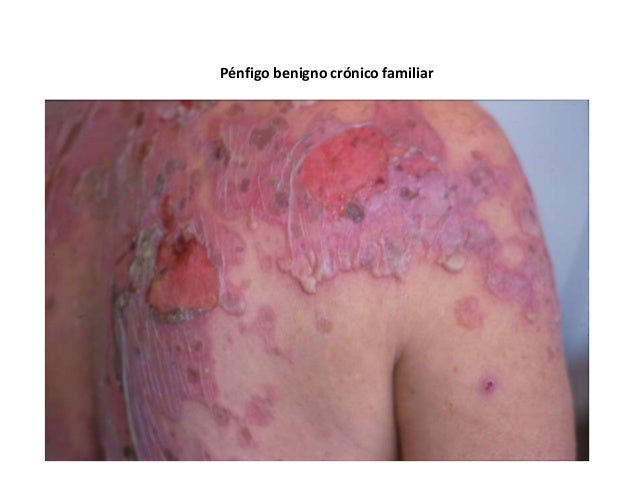 El ungüento eplan y la psoriasis