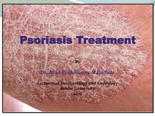 Psoriasis Treatment
By
Dr. Aliaa El-Husseiny M.Daifalla
Lecturer of Dermatology and Andrology
Benha University
2016
 