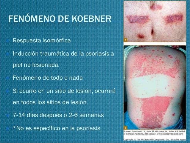 Atopicheskim por la dermatitis a los niños de la foto