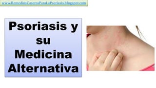 Psoriasis y
su
Medicina
Alternativa
www.RemediosCaserosParaLaPsoriasis.blogspot.com
 