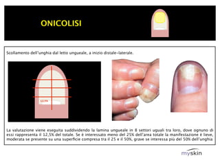 ONICOLISI


Scollamento dell’unghia dal letto ungueale, a inizio distale-laterale.




                  12,5%




La valutazione viene eseguita suddividendo la lamina ungueale in 8 settori uguali tra loro, dove ognuno di
essi rappresenta il 12,5% del totale. Se è interessato meno del 25% dell’area totale la manifestazione è lieve,
moderata se presente su una superﬁcie compresa tra il 25 e il 50%, grave se interessa più del 50% dell’unghia
 