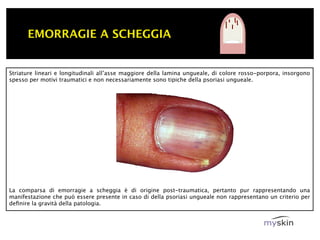 EMORRAGIE A SCHEGGIA


Striature lineari e longitudinali all’asse maggiore della lamina ungueale, di colore rosso-porpora, insorgono
spesso per motivi traumatici e non necessariamente sono tipiche della psoriasi ungueale.




La comparsa di emorragie a scheggia è di origine post-traumatica, pertanto pur rappresentando una
manifestazione che può essere presente in caso di della psoriasi ungueale non rappresentano un criterio per
deﬁnire la gravità della patologia.
 