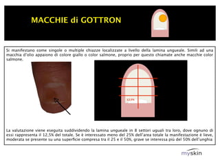 MACCHIE di GOTTRON


Si manifestano come singole o multiple chiazze localizzate a livello della lamina ungueale. Simili ad una
macchia d’olio appaiono di colore giallo o color salmone, proprio per questo chiamate anche macchie color
salmone.




                                                                12,5%




La valutazione viene eseguita suddividendo la lamina ungueale in 8 settori uguali tra loro, dove ognuno di
essi rappresenta il 12,5% del totale. Se è interessato meno del 25% dell’area totale la manifestazione è lieve,
moderata se presente su una superﬁcie compresa tra il 25 e il 50%, grave se interessa più del 50% dell’unghia
 