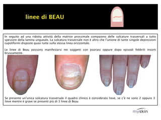linee di BEAU


In seguito ad una ridotta attività della matrice prossimale compaiono delle solcature trasversali a tutto
spessore della lamina ungueale. La solcatura trasversale non è altro che l’unione di tante singole depressioni
cupoliformi disposte quasi tutte sulla stessa linea orizzontale.

Le linee di Beau possono manifestarsi nei soggetti con psoriasi oppure dopo episodi febbrili insorti
bruscamente.




Se presente un’unica solcatura trasversale il quadro clinico è considerato lieve, se c’è ne sono 2 oppure 3
lieve mentre è grave se presenti più di 3 linee di Beau
 