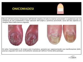 ONICOMADESI


Dovuta all’interruzione temporanea dell’attività mitotica di tutta la matrice prossimale si caratterizza per la
comparsa di uno scollamento a tutto spessore dell’unghia a partenza prossimale, ossia dal lato opposto al
margine libero della lamina ungueale.




Di solito l’onicomadesi è di origine post-traumatica, pertanto pur rappresentando una manifestazione della
psoriasi ungueale non viene normalmente valutata per deﬁnire l’entità della patologia
 