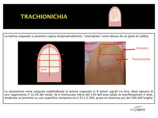 TRACHIONICHIA


La lamina ungueale si presenta rugosa longitudinalmente, “smerigliata” come abrasa da un getto di sabbia.



                                                                                                  Onicolisi


                                                                                               Trachionichia


                           12,5%




La valutazione viene eseguita suddividendo la lamina ungueale in 8 settori uguali tra loro, dove ognuno di
essi rappresenta il 12,5% del totale. Se è interessato meno del 25% dell’area totale la manifestazione è lieve,
moderata se presente su una superﬁcie compresa tra il 25 e il 50%, grave se interessa più del 50% dell’unghia
 